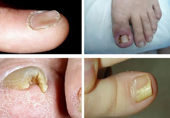 Az onychomycosis tünetei a lábakon