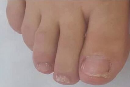 márka fungent márka gyorsan megszabadult a mycosis -tól